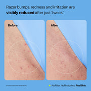 Peach Slices - Smoothing Solution Ingrown Hair Treatment (1.69 oz) - Smooth, Relieve, Soften Skin - 360 Roller - BHA, AHA, PHA, Niacinamide, Licorice - Vegan & Cruelty Free - Korean Skin Care & Beauty